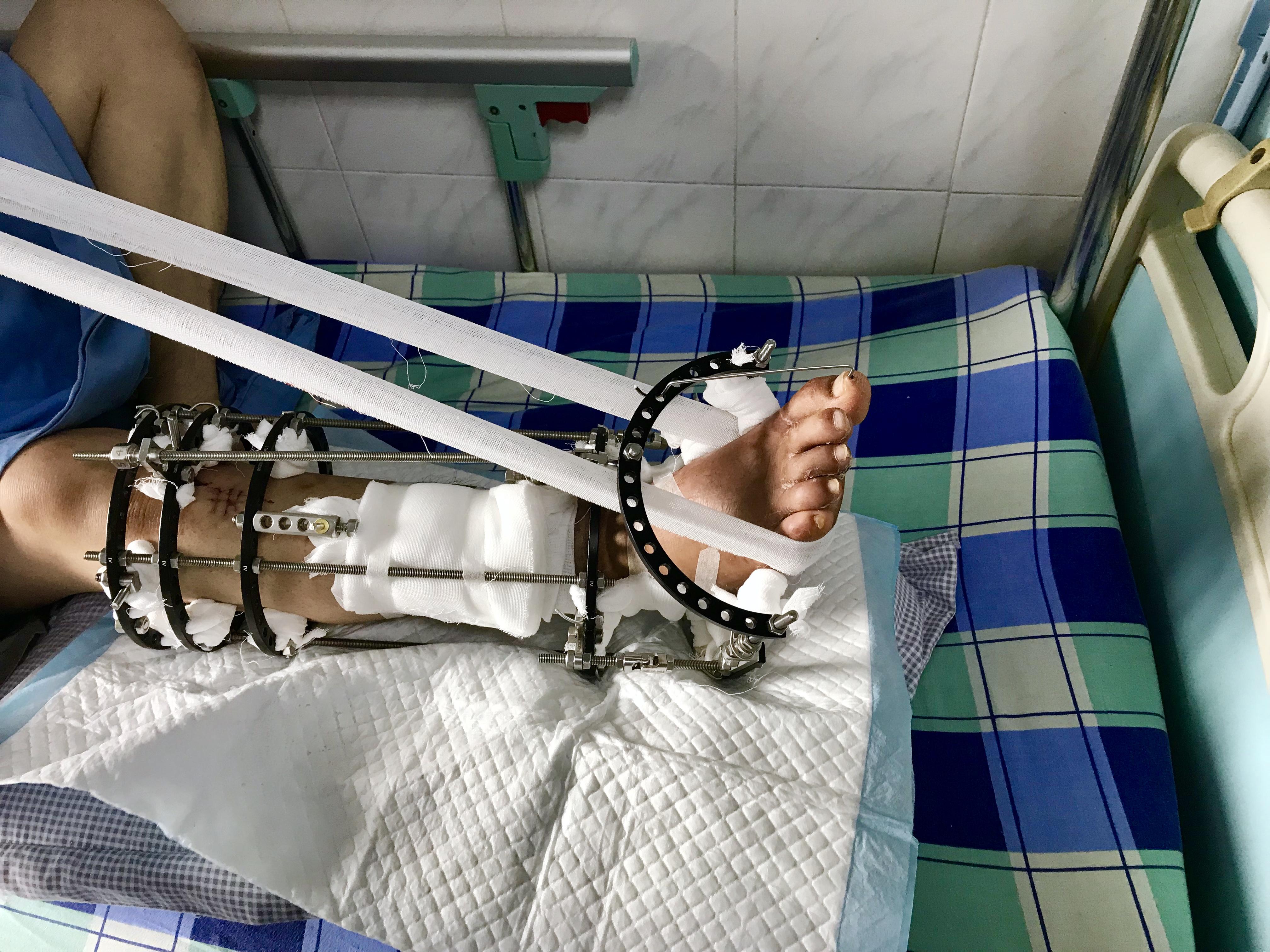外固定支架患者术后功能锻炼