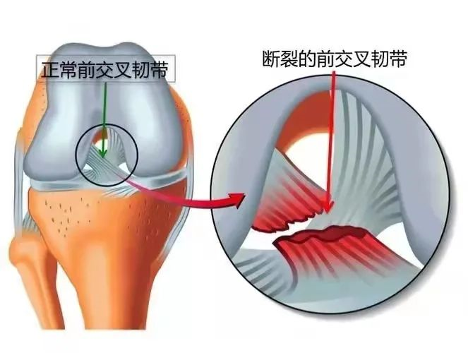 【健康科普】如何预防前交叉韧带的损伤，请听专家健康课堂
